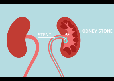 Kidney stones and ureteral stents: Credible patient resources